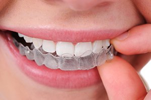 Clear Aligners