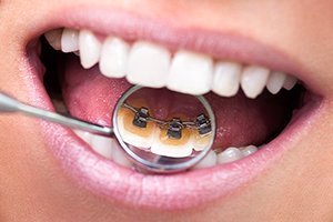 Lingual braces