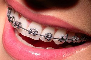 Metal braces