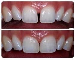 diastema-closure